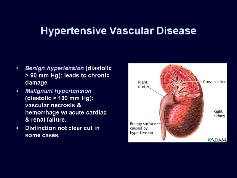 Hypertensive Vascular Disease Benign hypertension (diastolic > 90 mm Hg): leads to chronic damage.